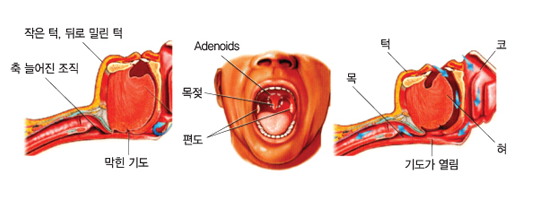 작은 턱, 뒤로 밀린 턱, 축 늘어진 조직, 막힌 기도, 목젖, 편도, 목, 턱, 코 ,혀 ,기도가 열림
