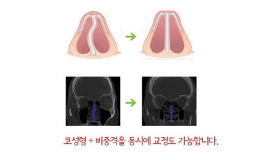 코성형+비중격을 동시에 교정도 가능합니다.